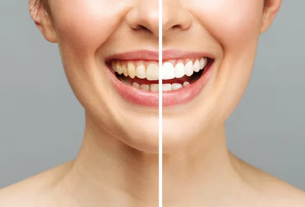 Tooth Colour Fillings