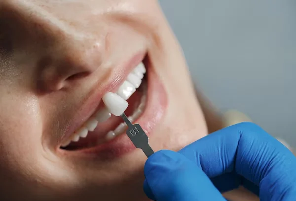 Veneers or Laminates