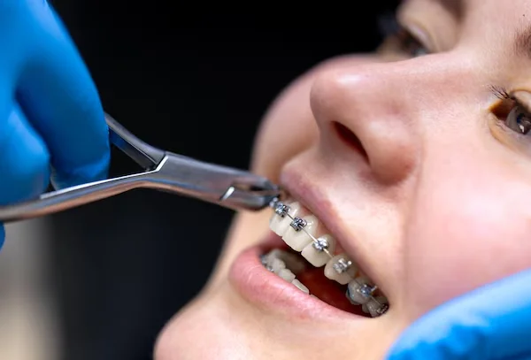 Braces