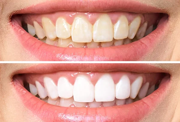 Tooth Whitening