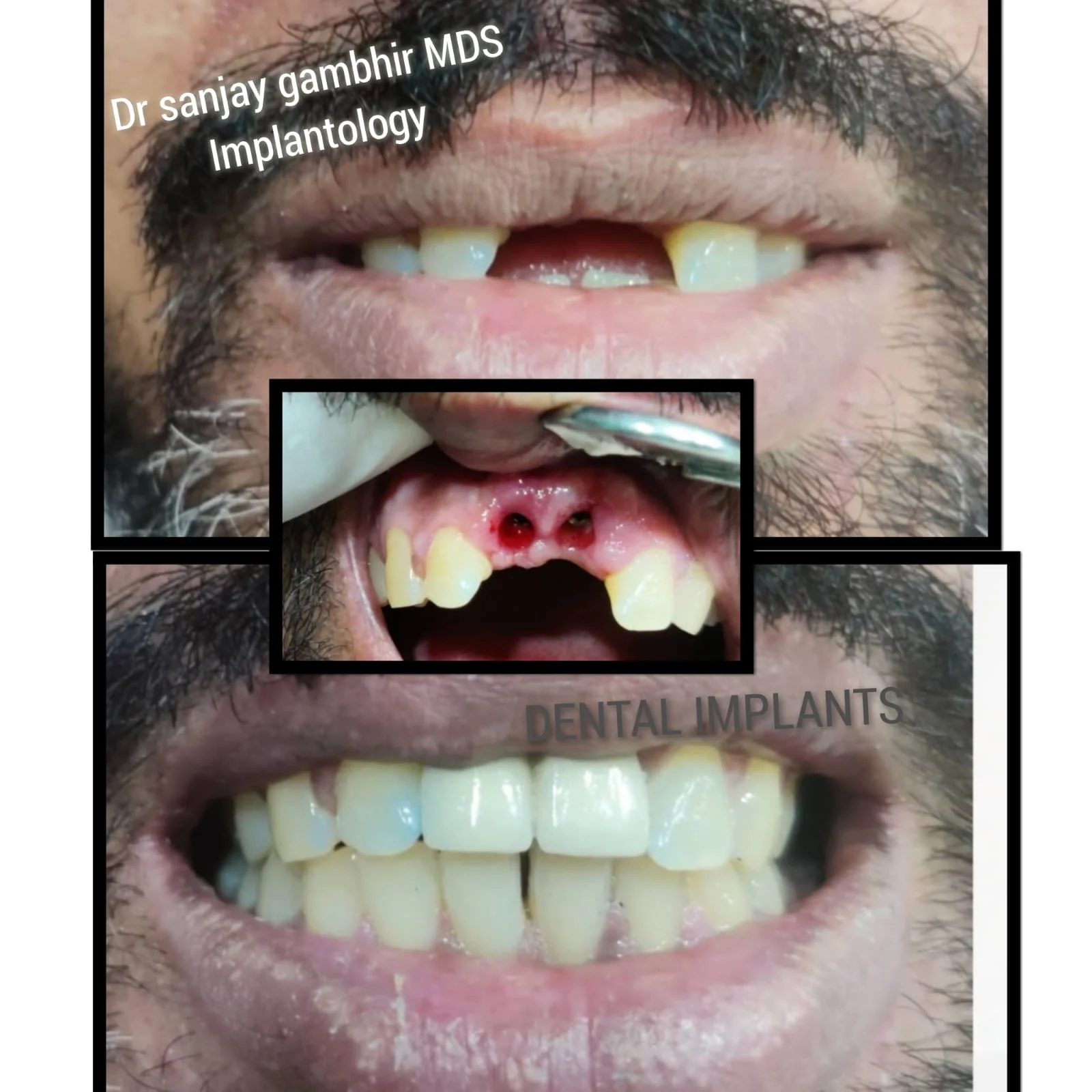 Missing a Tooth? Know When an Implantologist Can Help
